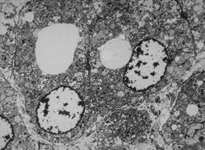 M, | newborn mitochondrial cardiomyopathy … autopsy sample from liver